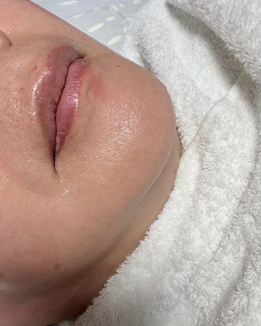 施術前の頬周りの写真